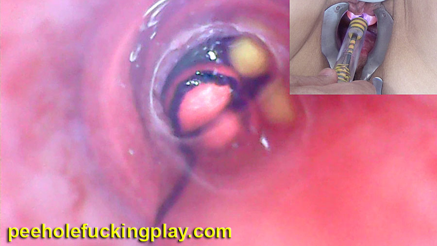 Endoscope camera in peehole urethral sounding in woman bladder with balls